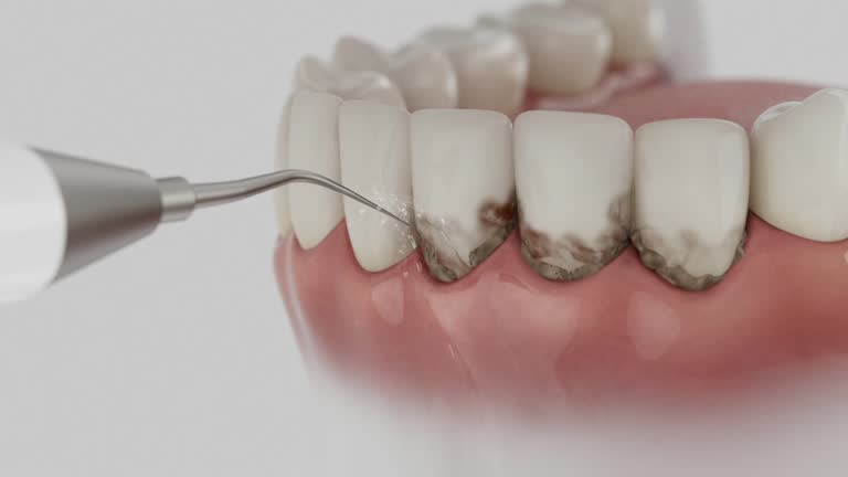 Trusted Wisdom Tooth Removal service in Saticoy, CA - Dentist Open Now